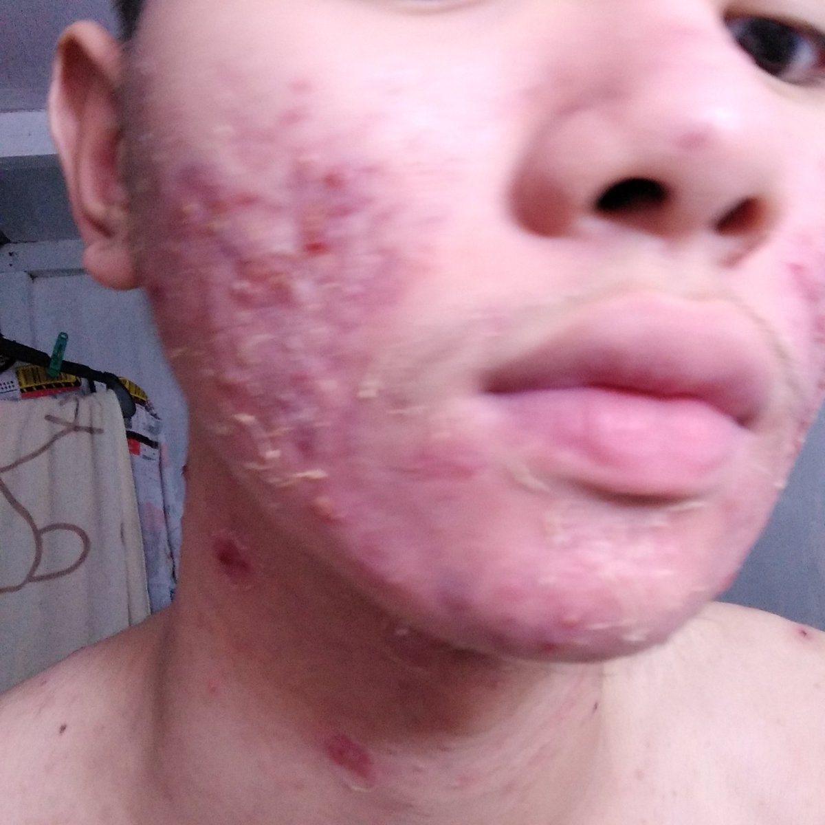 "Anong nangyari sa mukha mo?""Gwapo ka sana, kaso may pimples.""Yucks! Nag memake up ka? Kaya pala na irritate."Mga masasakit na salitang natanggap ko before. Hindi ko na alam anong gagawin ko. Natakot akong magpa derma, isa pa wala akong pera ipang gagasto. Sad.