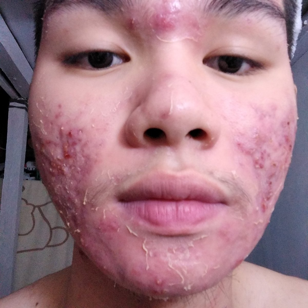 NOT HAVING CLEAR SKIN is my greatest insecurity. I& #39;m not totally CLEAR SKIN now but, look at the difference.