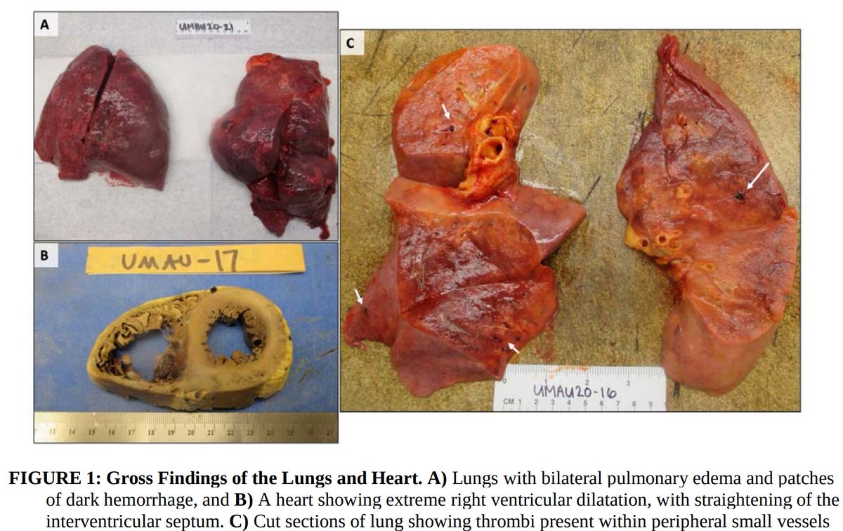 1. Pulmonary microvascular thrombosis with diffuse alveolar damage (DAD). Early reports described “marked inflammatory changes including mononuclear cell infiltrates, virally infected cells, and DAD”.2. Increased VTE incidence, with both microvascular thrombosis and PE.