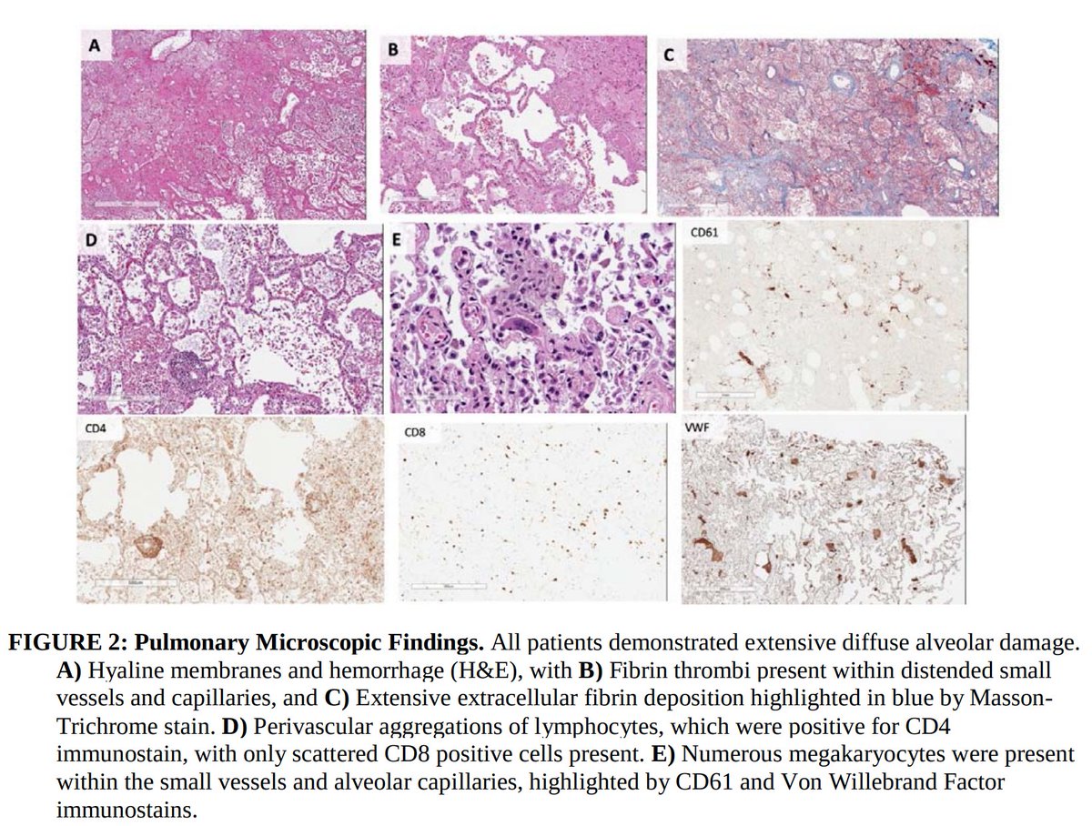 1. Pulmonary microvascular thrombosis with diffuse alveolar damage (DAD). Early reports described “marked inflammatory changes including mononuclear cell infiltrates, virally infected cells, and DAD”.2. Increased VTE incidence, with both microvascular thrombosis and PE.