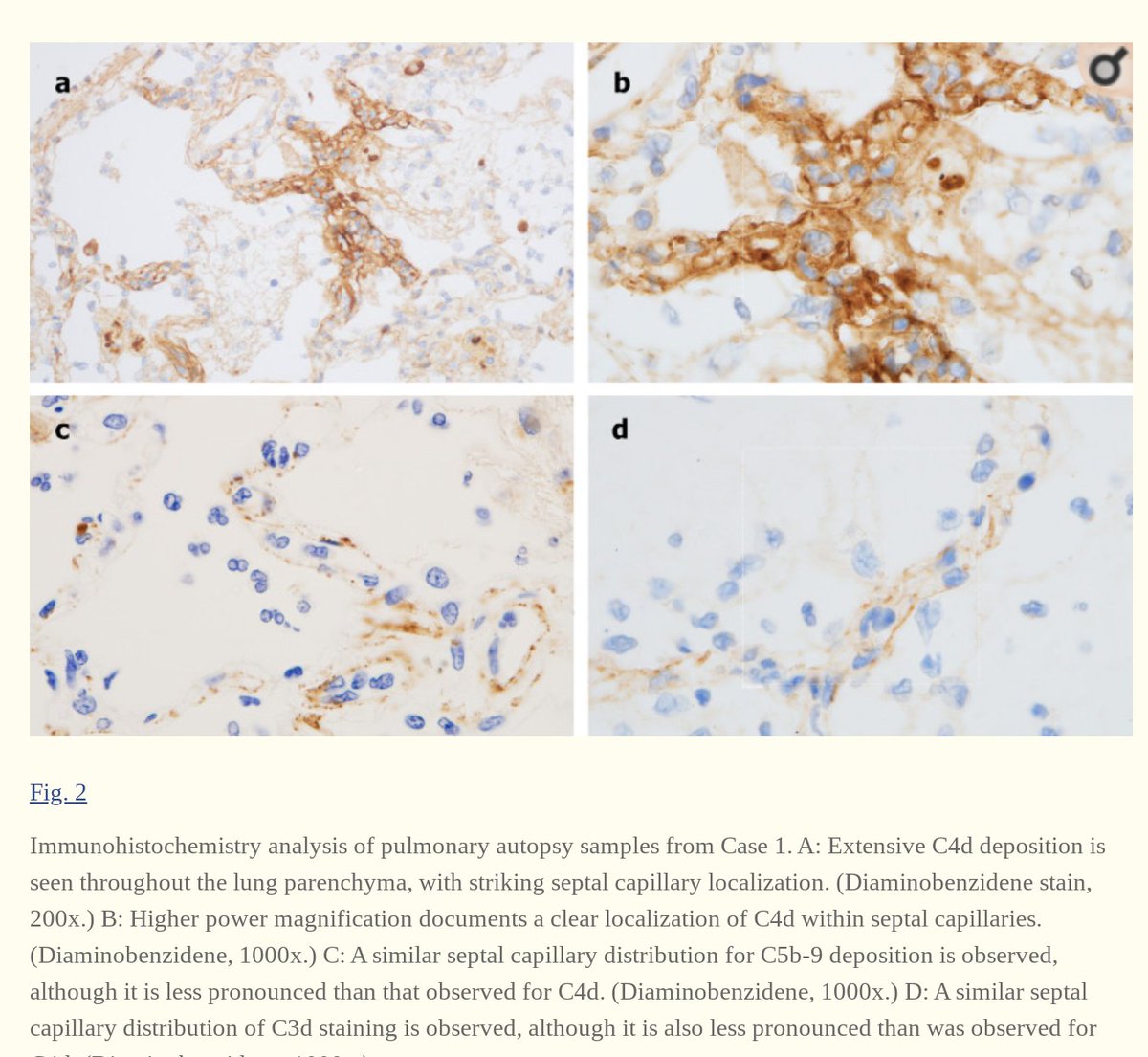 3. Complement deposition, with a striking localization to the capillary beds. Notably, co-localization of SARS-CoV-2 envelope proteins has been seen with complement components in dermal tissues and pulmonary microvessels.