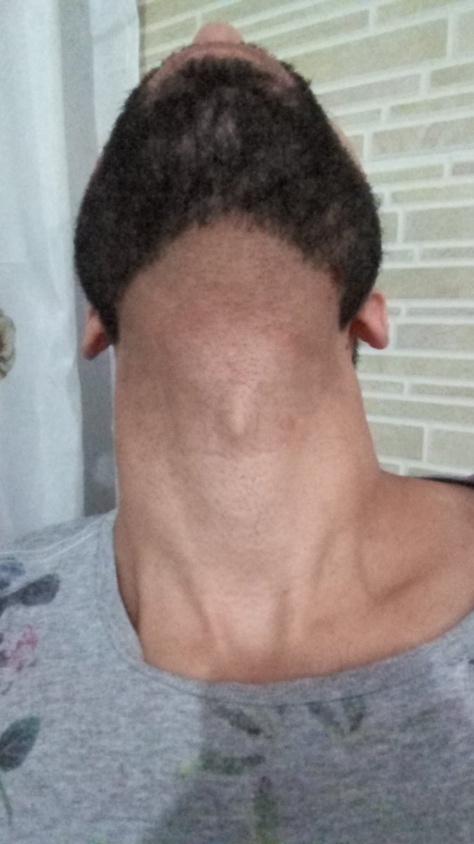 KiwiSvm's tweet photo. Fui tirar foto do pescoço pra mostrar que fiz a barba e descobri que tem um rosto humanoide preso na minha garganta. https://t.co/KtbhOEvA1M