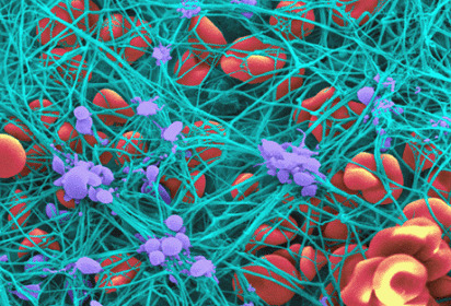 Also, this is partly why fibrinogen is an acute phase reactant!circulating fibrinogen = more scaffolding material available = better bacterial defense.In fact, marked hyperfibrinogenemia (i.e. >700 mg/dL)  platelet interaction, viscosity, and confers AC resistance!