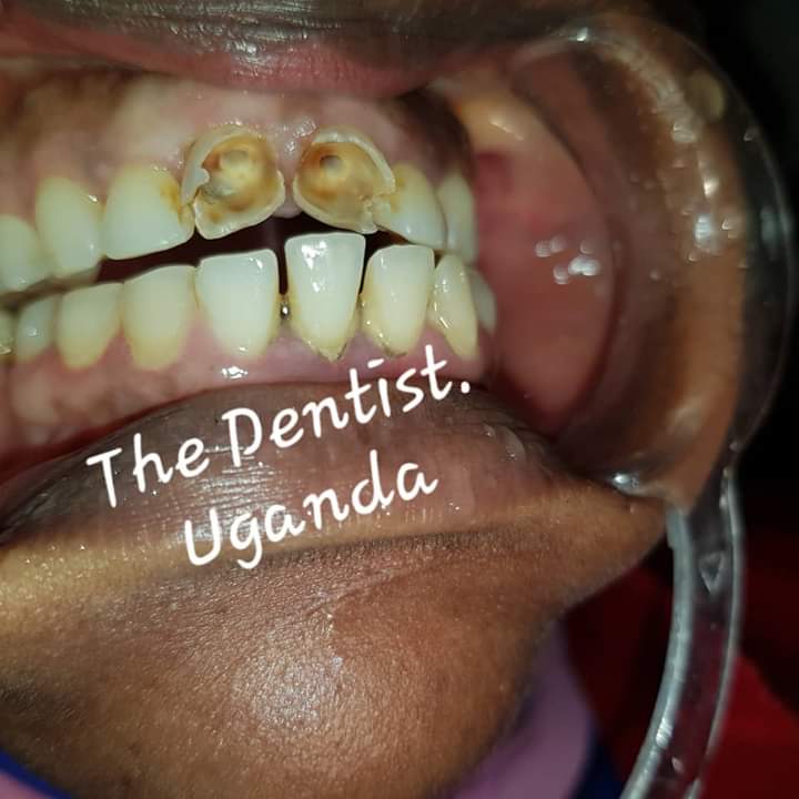 The dentist. Uganda on Twitter "Front teeth Reconstruction A 24years young lady came tired of