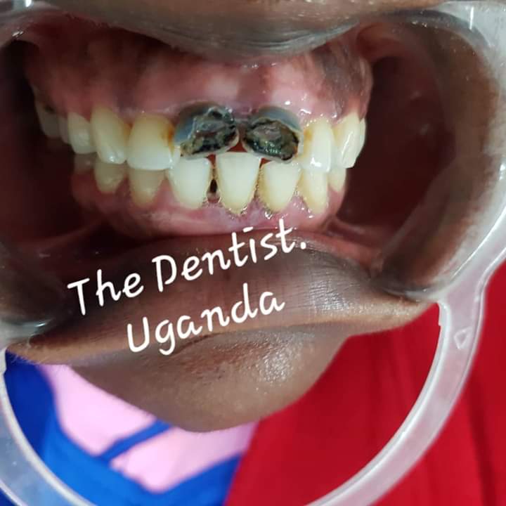 The dentist. Uganda on Twitter "Front teeth Reconstruction A 24years young lady came tired of