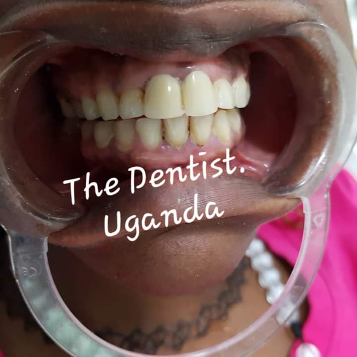 The dentist. Uganda on Twitter "Front teeth Reconstruction A 24years young lady came tired of