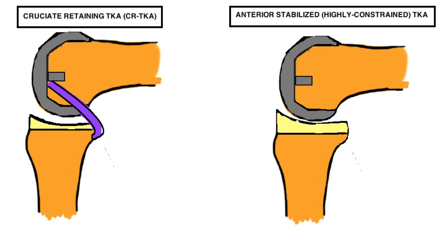 Orthobullets on Twitter "An anterior stabilized knee prosthesis is