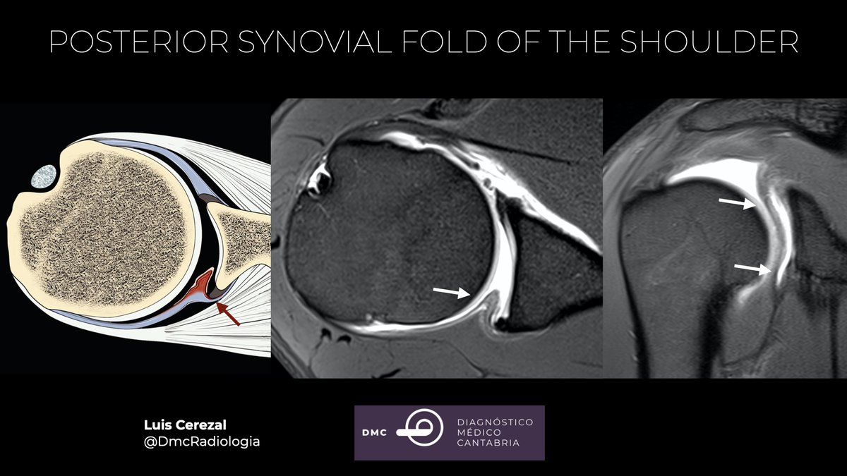 DmcRadiologia's tweet photo. #SMSKfromTheCave 
Posterior synovial folds of the shoulder are a relatively common finding on MR arthrography.  The vast majority are asymptomatic. However, the cord-like types may extend to the glenohumeral joint and be trapped, causing impingement https://t.co/yMvMzY8bOu