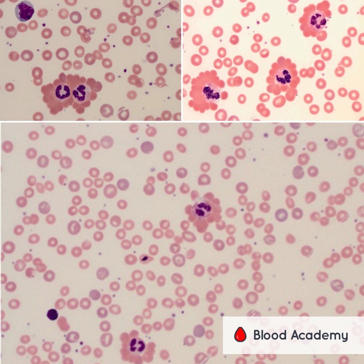 blood_academy's tweet photo. Blood film images from a 19‐year‐old female with fatigue and jaundice.

What does the blood film show and what could be the cause?

Answers tomorrow!

subscribe today at https://t.co/f6RvqU0AHa to continue your learning

#hematology #hempath #bloodsmear #pathology https://t.co/wreiV64am6