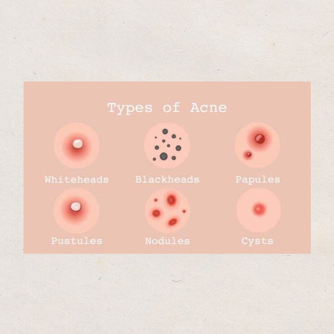 Apa itu PAPULES acne, ianya adalah bump under skin surface. Bentuknya solid dan tender. Berwarna pink. Selalunya skin around the papule sedikit bengkak.