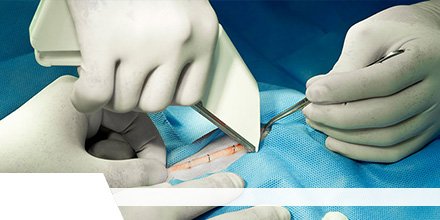 Global #SurgicalStaplers Market Insights, Forecast to 2026

Read at- bit.ly/2Ybtgto

Get sample of report at- bit.ly/2KFcfja

@FrankenmanEMEA @bbraun_de <a href="/BDandCo/">BD</a> 
<a href="/IntuitiveSurg/">Intuitive</a> <a href="/Medtronic/">Medtronic</a> <a href="/JNJMedDevices/">JNJMedDevices</a>