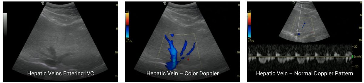 (4/10) Step 2: Evaluate Hepatic Venous Doppler: https://pocus101.com/vexus 1. Get Image of IVC and hepatic veins.2. Place color flow Doppler over the hepatic veins. (Should see BLUE-away)3. Place your Pulse Wave Doppler gate on a hepatic vein4. Initiate Pulse wave Doppler