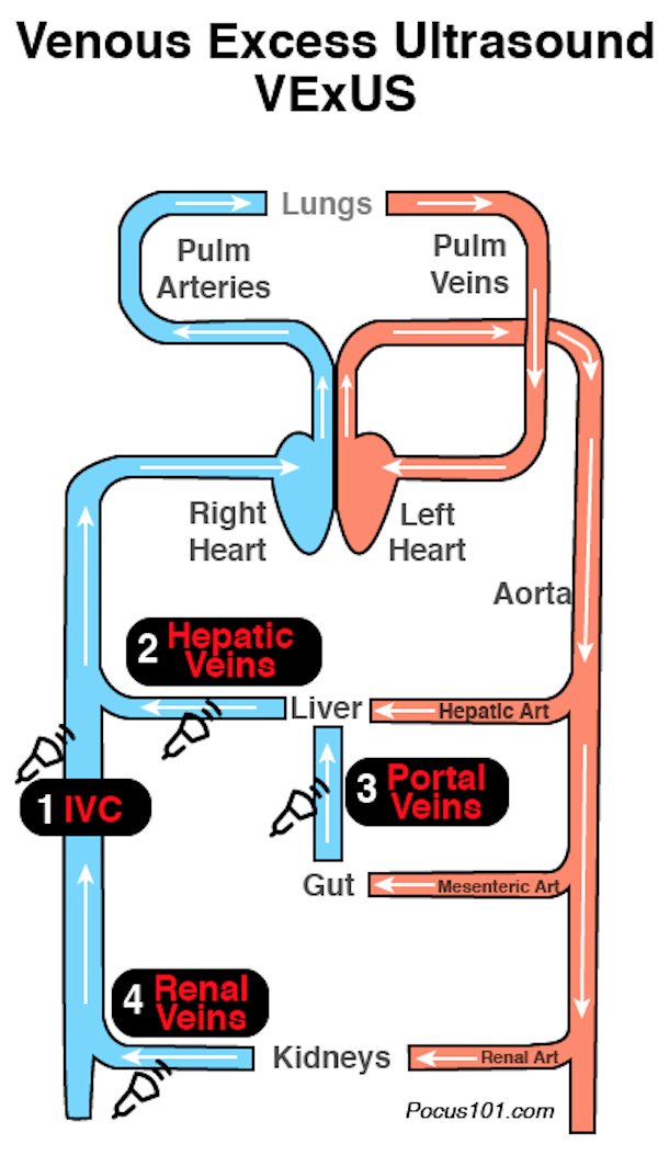 Stop KILLING Your Patients with Fluid! Learn how to avoid Fluid Overload with Venous Congestion Evaluation using  #POCUSNew BLOG POST on the  #VExUS Protocol! Step By Step Guide, Downloadable PDF Pocket Guide, & Calculator  https://pocus101.com/vexus  #medtweetorial(1/10)