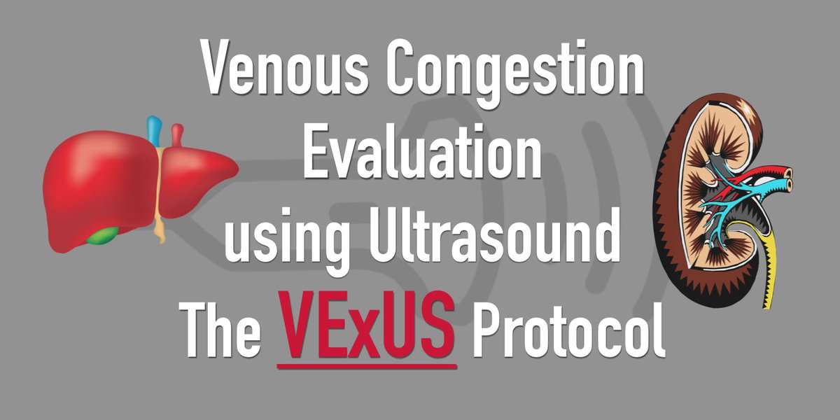 Stop KILLING Your Patients with Fluid! Learn how to avoid Fluid Overload with Venous Congestion Evaluation using  #POCUSNew BLOG POST on the  #VExUS Protocol! Step By Step Guide, Downloadable PDF Pocket Guide, & Calculator  https://pocus101.com/vexus  #medtweetorial(1/10)