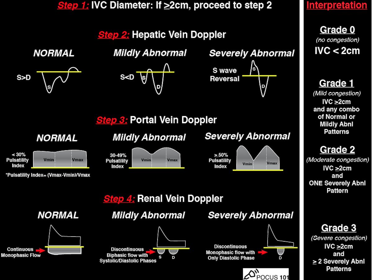 Stop KILLING Your Patients with Fluid! Learn how to avoid Fluid Overload with Venous Congestion Evaluation using  #POCUSNew BLOG POST on the  #VExUS Protocol! Step By Step Guide, Downloadable PDF Pocket Guide, & Calculator  https://pocus101.com/vexus  #medtweetorial(1/10)