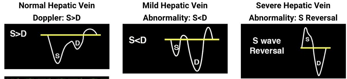 (5/10) Interpret Hepatic Venous Doppler Tracing.  https://pocus101.com/vexus 