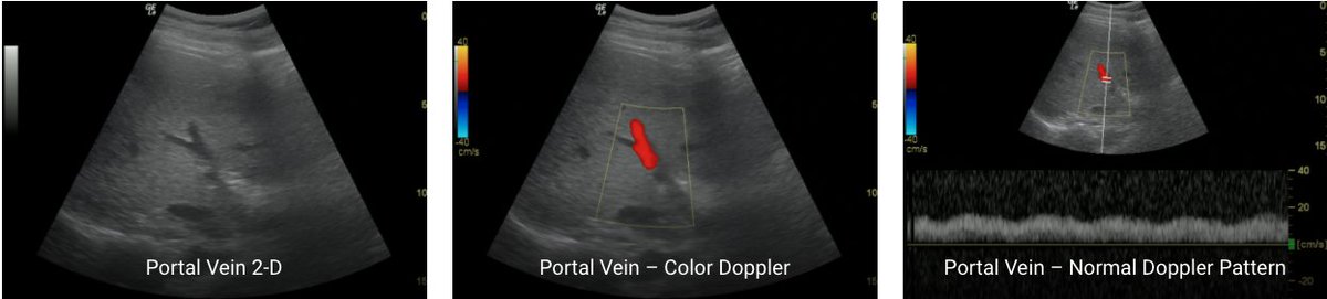 (6/10) Step 3: Evaluate Portal Venous Doppler: https://pocus101.com/vexus 1. Get 2D image of the Right Portal Vein2. Place color flow Doppler over Portal Vein (Should See RED-toward)3. Place your pulse wave Doppler gate on the Portal Vein4. Initiate Pulse wave Doppler