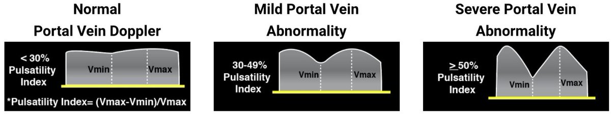 (7/9) Interpret Portal Venous Doppler Tracing.  https://pocus101.com/vexus 