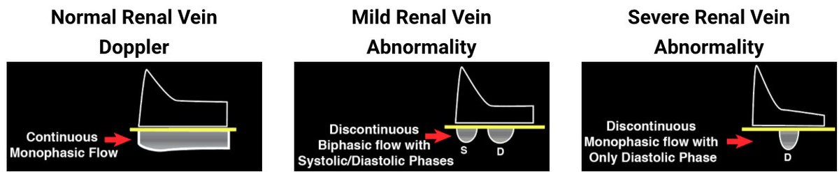 (9/10) Interpret Renal Venous Doppler Tracing.  https://pocus101.com/vexus 