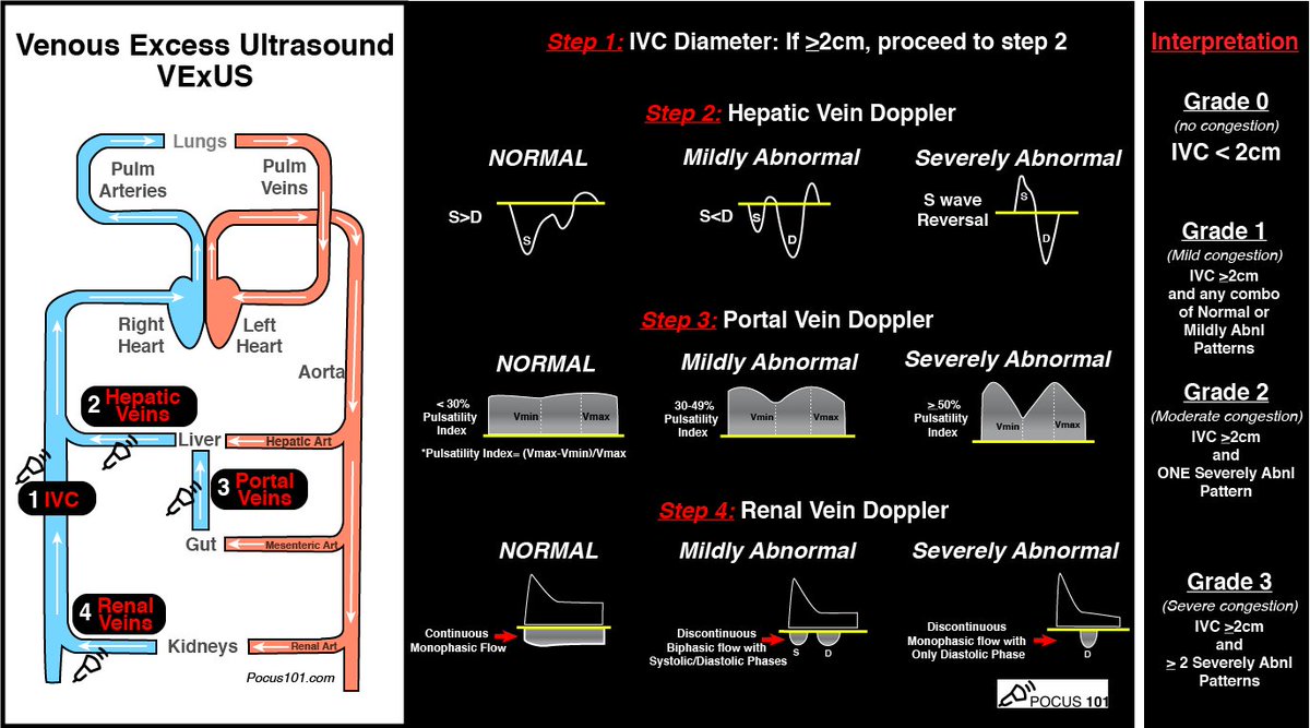 (9/10) VExUS Severity Grading:Download PDF!  https://pocus101.com/vexus Grade 0: IVC <2cm = NO CongestionGrade 1: IVC >=2cm with any combo of Normal or Mildly Abnl PatternsGrade 2: IVC >=2cm and ONE severely Abnl PatternGrade 3: IVC >=2cm and >2 Severely Abnl Patterns