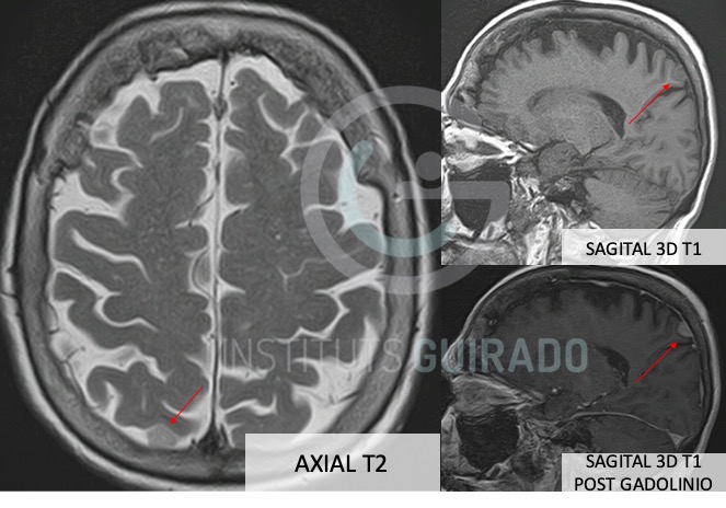 inst_guirado's tweet photo. Proceso expansivo extra-axial parieto-occipital derecho de aproximadamente 8,3 × 10 × 9 mm con realce dural lineal adyacente en relación con la existencia de un pequeño meningioma. 
#radiologia #radiology #diagnostico #neurology #tsid #radiographer https://t.co/GzhlV5i4od