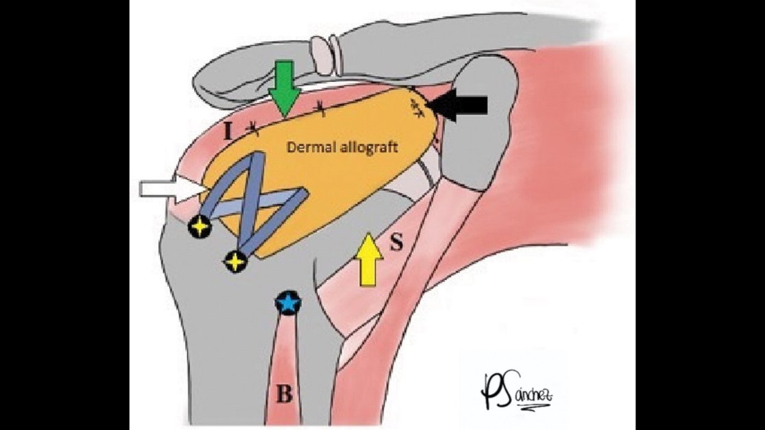 Does your patient have a #rotatorcufftear that is not amenable to primary repair or arthroplasty? Superior capsular reconstruction may be the best option—if specific tissue quality and tear type criteria are met. bit.ly/32Ljvm1 #MSKRad