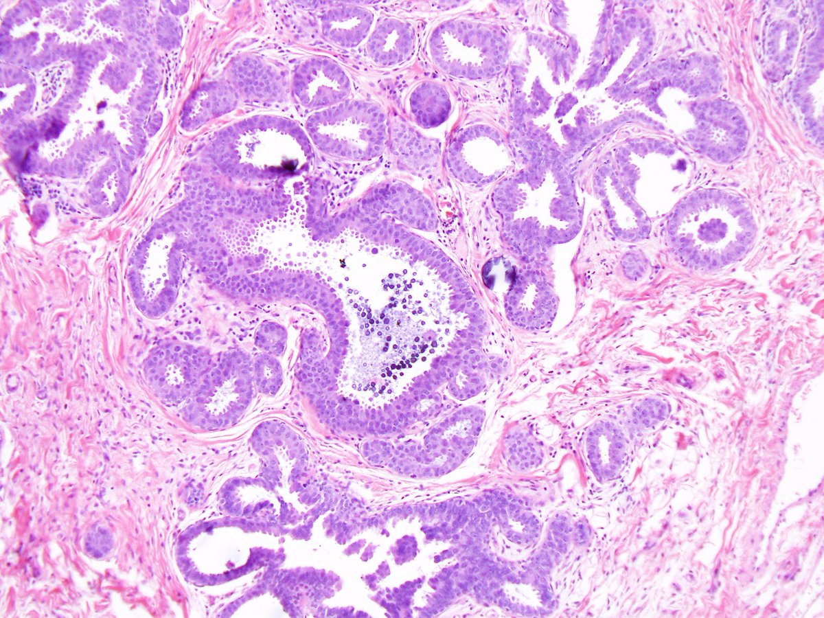 Reza Eshraghi Fea Lobular Acini Cytologic Atypia Uniform Round Centrally Located Nuclei With Lost Of Polarization Nuclear Pleomorphism Tall Hyperchromatic Nuclei Ihc Er Pr Uniform Prominent Ck 5 6 Usually Negative Ar