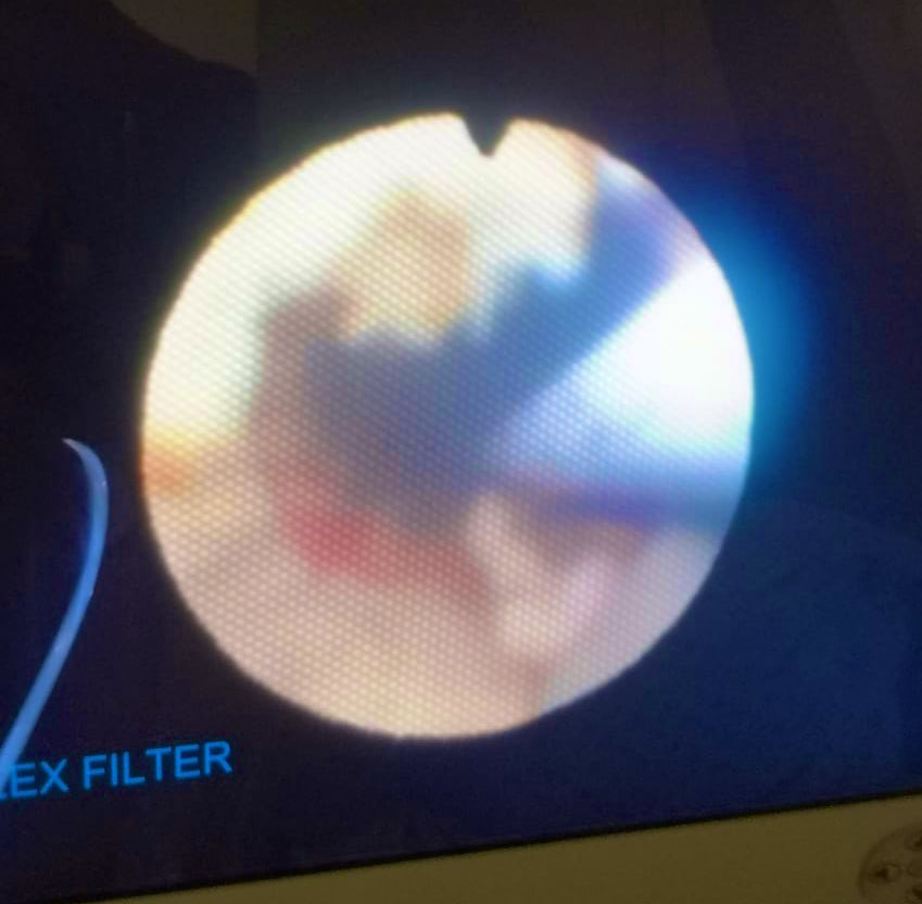 Infundibular stenosis caused by fibrosis of upper calyx, open by laser under renoscopy, tips: use low energy , high frequency, start opening in areas with scar, pale or mimic Randall plaque lesions, pass a guide. Leave  catheter jj for one month and wait for re-epithelialization.