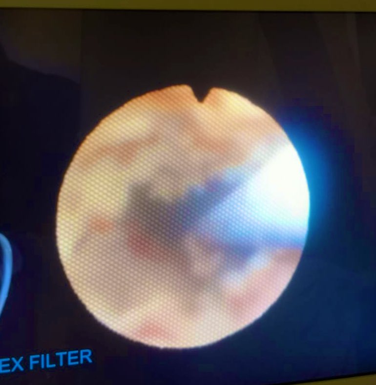 PCNL challenges tweet media