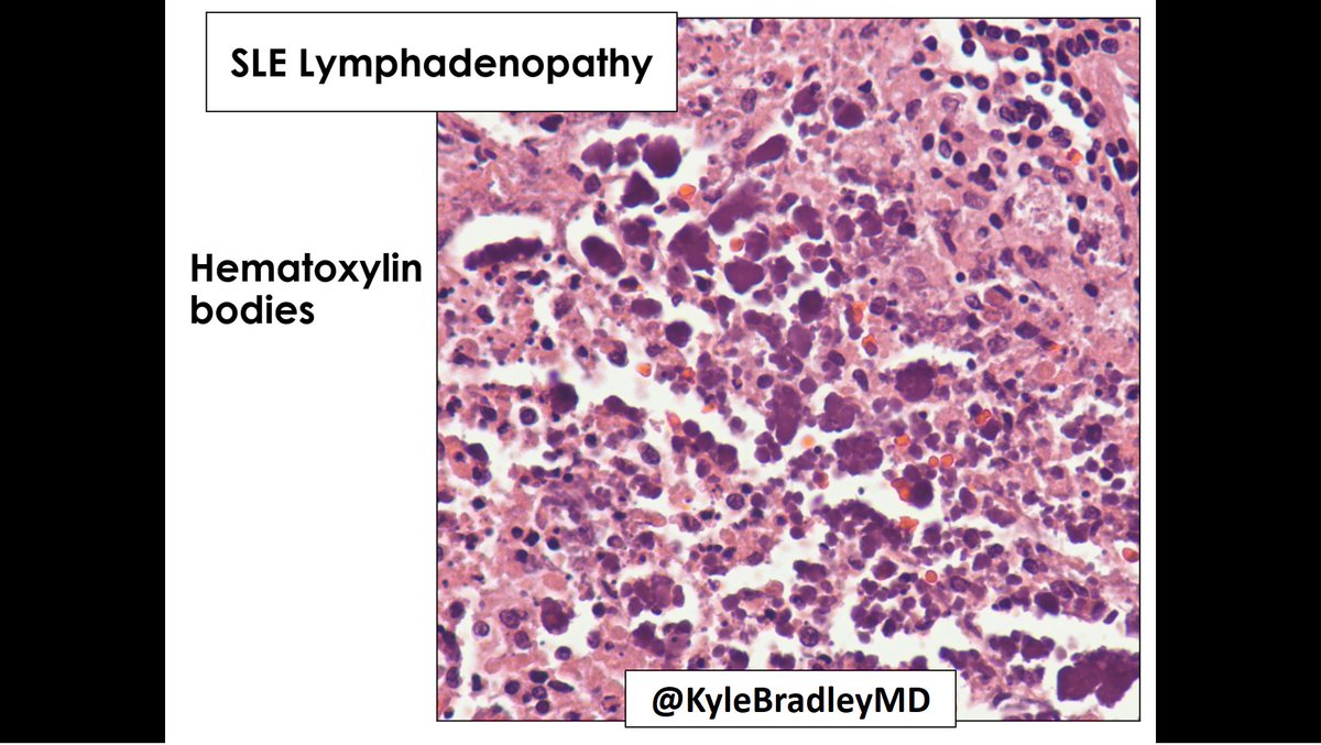 Classic hematoxylin bodies characteristic of lupus lymphadenopathy.

Extracellular clumps of amorphous material that stain intensely with hematoxylin.

Thought to be degenerated nuclei that have reacted with ANAs.

#CAPVirtualPath