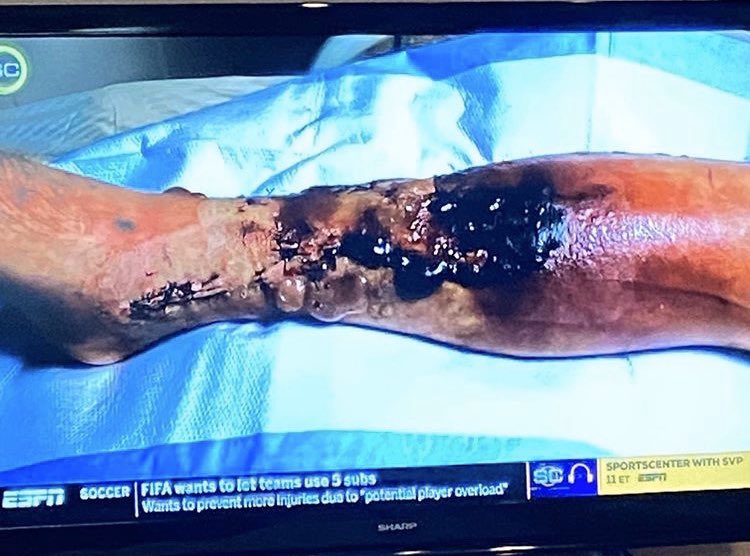 wshingtontoday's tweet photo. Alex Smith’s leg 4 days after his injury...... https://t.co/HKqunt0bQP