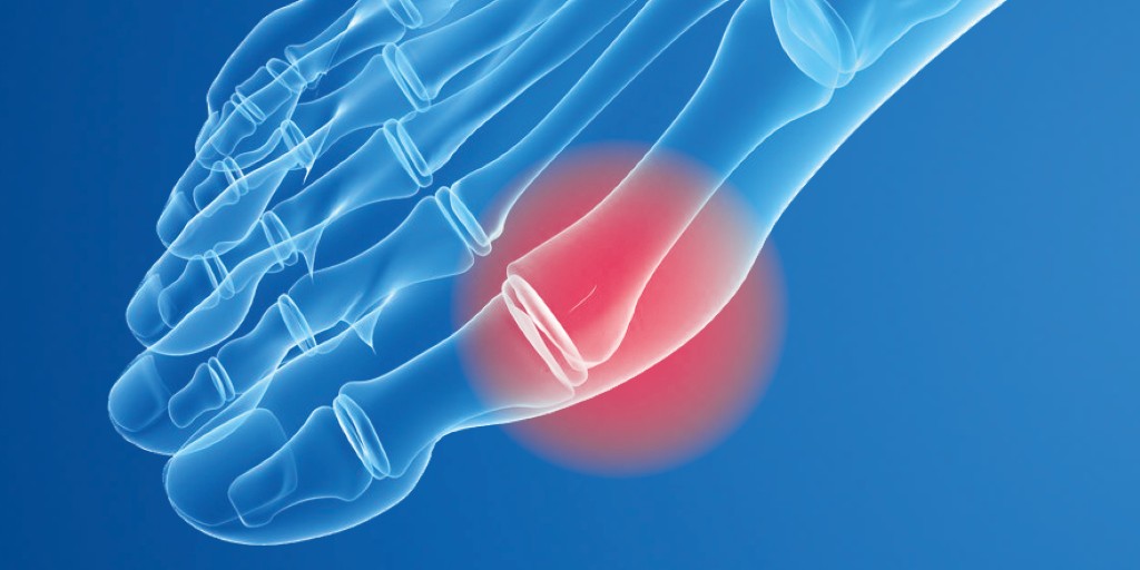 Do you suffer with #Bunions? A bunion is a bony deformity of the joint at the base of the big toe.  Our inner longitudinal arch support reaches under the 1st metatarsal, raising it to distribute bodyweight evenly. 

#FootCare #FootHealth