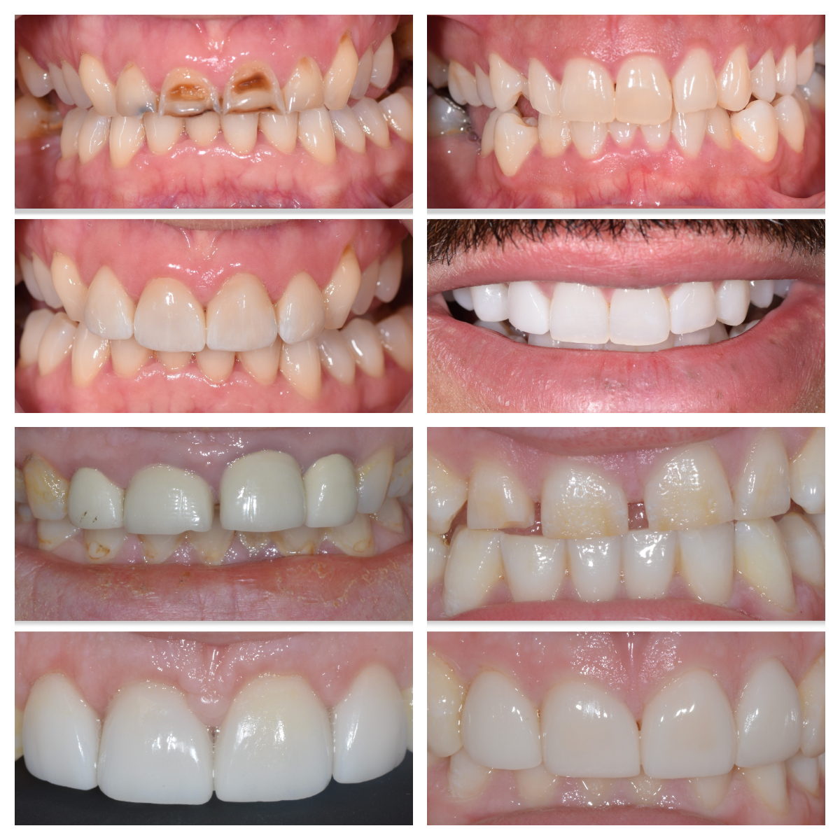 infinity_teeth's tweet image. Every individual is unique which is why every #smile created at Infinity Dental Clinic is different. In all of these cases we have improved our patient's smiles by achieving a look harmonious with the patient's desired smile outcome.