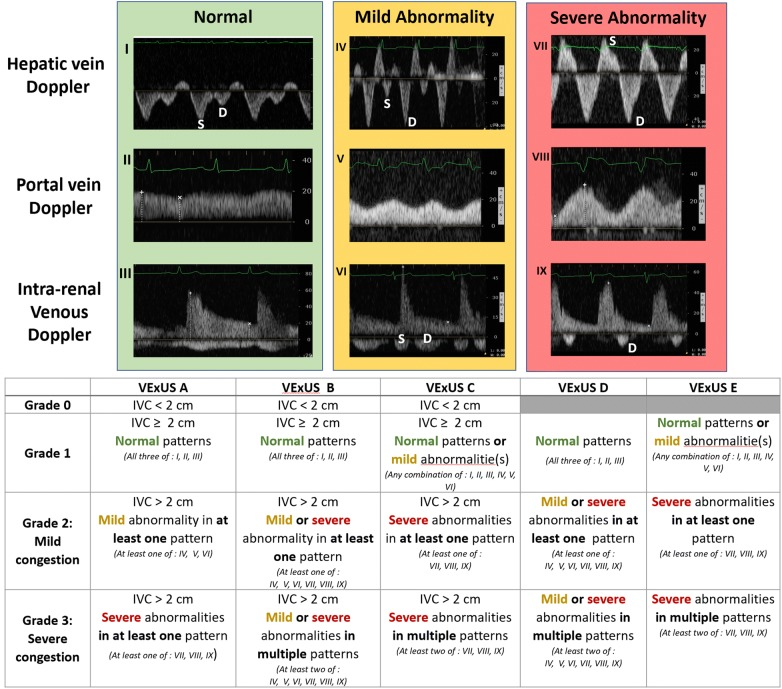 O Xrhsths Nephropocus Sto Twitter 2 What Is Included In Venous Excess Grading By Ultrasound Landmark Paper By Wbeaubien Thinkingcc Khaycock2 Emnerd Ad12andre Et Al Https T Co Lr1eerde9l Https T Co Ysq0z6l210