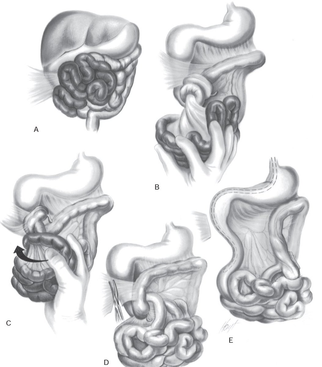 Pasos del procedimiento de Ladd (cirugía para malrotación intestinal)
1.Evisceración
2.Devolvulación (sentido antihorario)
3.Liberación de bandas de Ladd
4.Apendicectomía profiláctica
5.Colocar int. delgado lado derecho del abdomen, grueso del lado izquierdo.
#SoMe4PedSurg
