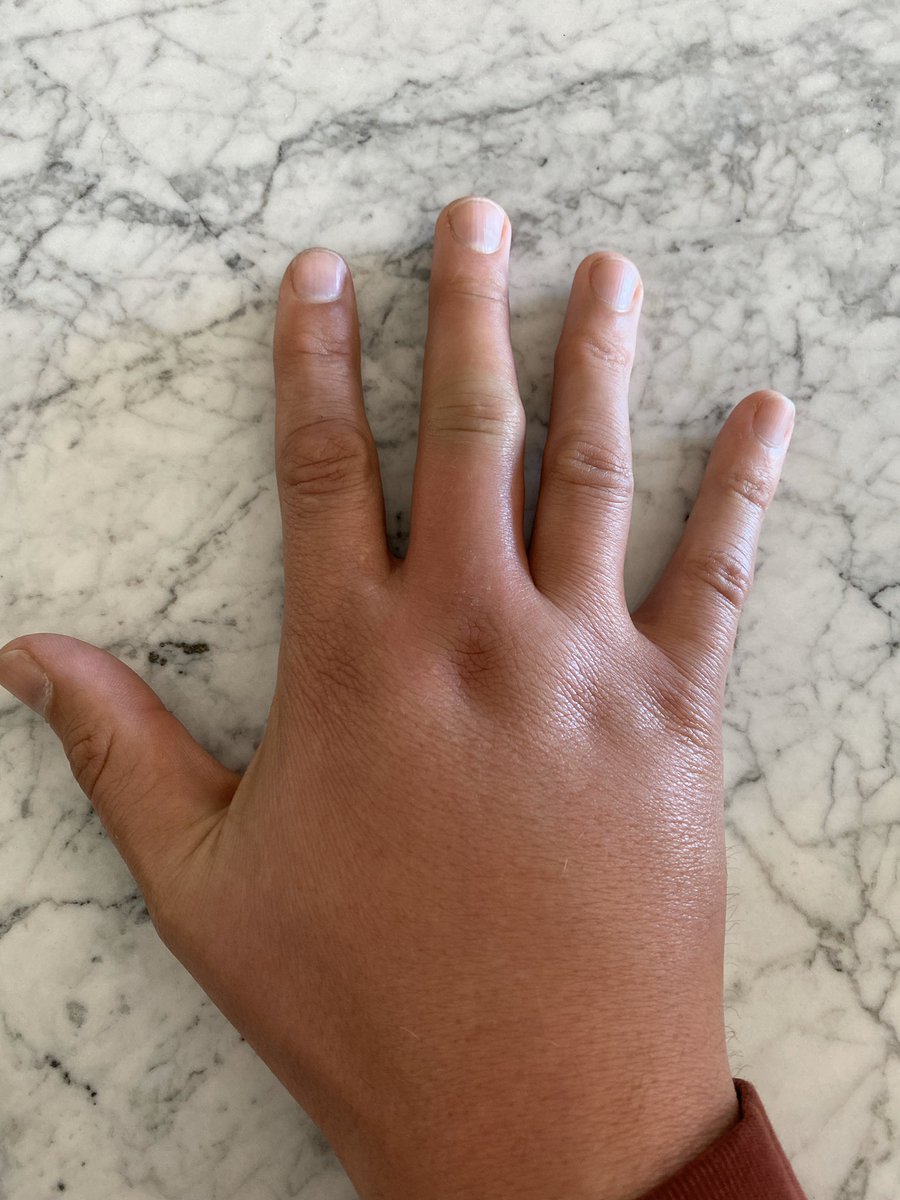 Bee stings to the middle finger. Balloon hands.