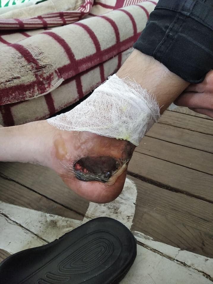 AlexPanchenko2's tweet photo. Foot of one of the 1K+ #Ukraine Emergency Service #firefighters tackling the #ChernobylFires last week. Probably stayed in battle due to sense of duty. Or maybe didn't notice the injury in time: in stupor caused by stress, widely-reported sleep deprivation and smoke intoxication. https://t.co/5NuzWHDLVP