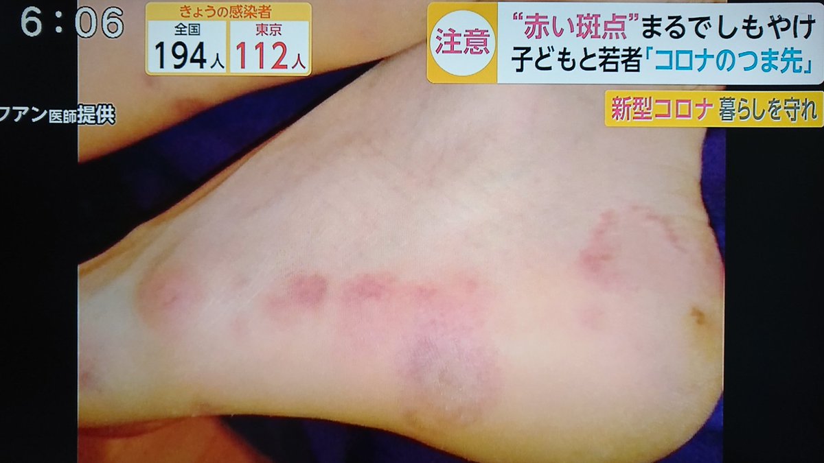 Take7700 A Twitter 子供や若い感染者の手足に赤い斑点 詳しい事は不明ですが ウイルスが血栓を作っているのかも 30 40代の感染者に脳梗塞が多いのはこれが関係している可能性が ただし医学的にはまだ確定されていません 新型コロナウイルス 緊急事態宣言