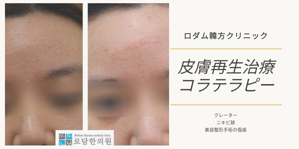 ロダム韓方クリニック Twitter वर クレーター傷痕 コラテラピーの施術前後写真 傷の状態によって施術回数が変わってきます 5ミリ基準 1つ 5万w 頬全体だと30 70万w ニキビ痕 クレーター 美容整形 水疱瘡痕 クレーター族 美容鍼 毛穴 手術痕 韓国 毛穴 ロダム韓方クリニック Twitter वर クレーター傷痕 コラテラピーの施術前後写真 傷の状態によって施術回数が変わってきます 5ミリ基準 1つ 5万w 頬全体だと30 70万w ニキビ痕 クレーター 美容整形 水疱瘡痕 クレーター族 美容鍼 毛穴 手術痕 韓国 毛穴