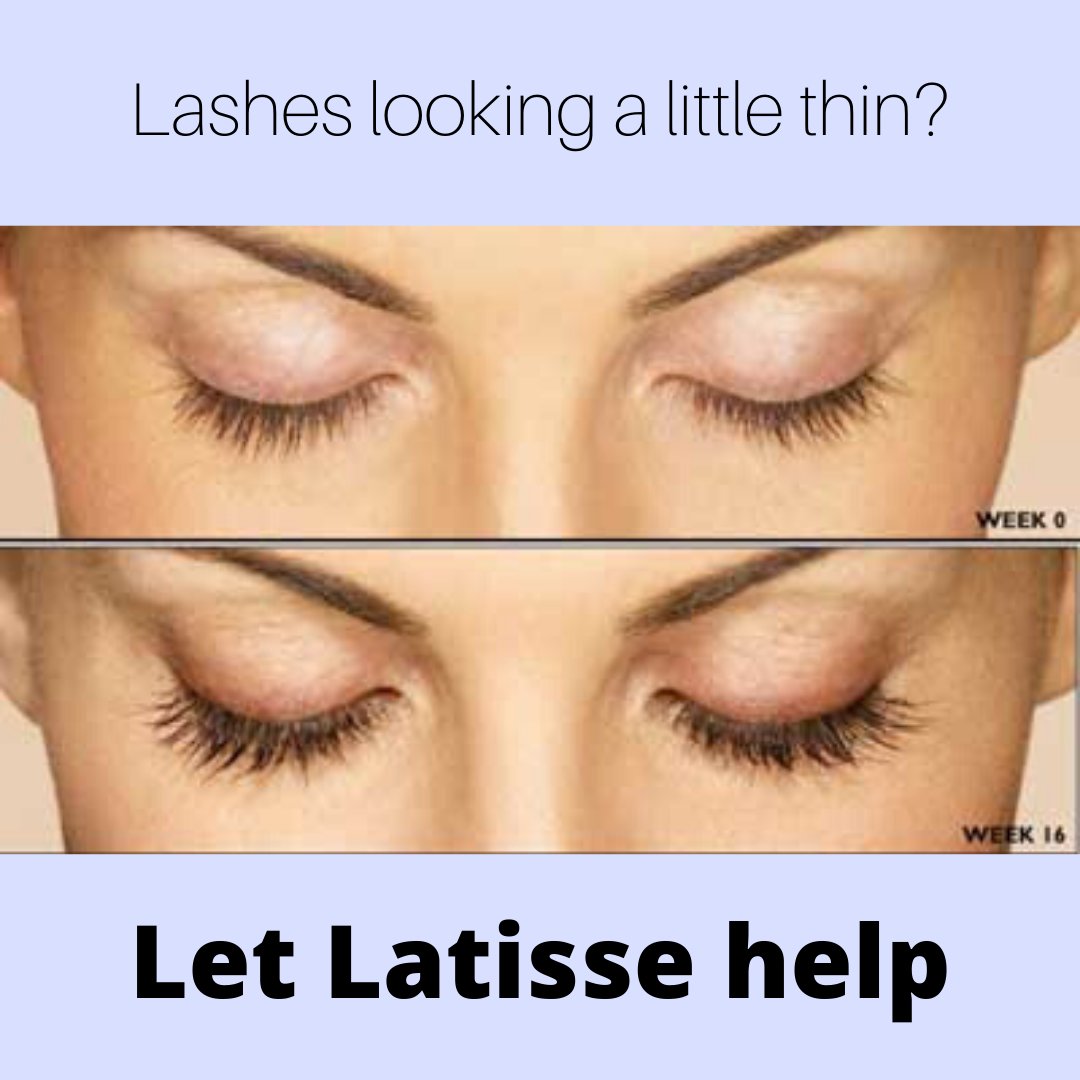 Lashes a little worse for the wear?
Consider Latisse! The only FDA-approved treatment clinically proven to grow lashes! See growth in as little as 4 weeks with full effects in 16 weeks!
#yyc #lashesyyc #lashesonlashes #latisse #latisselashes #optometry #selfisolation #selfcare