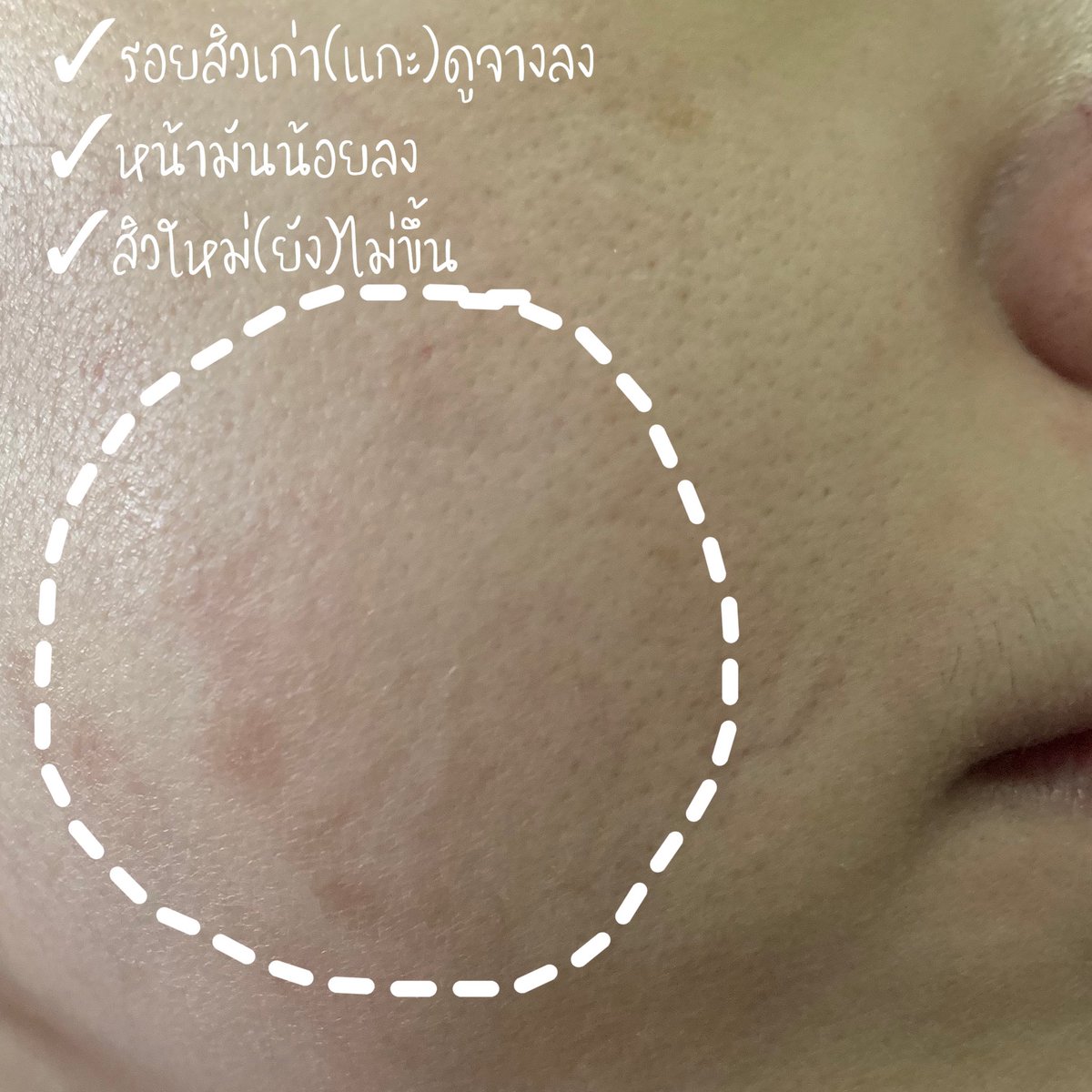 aMustSHOP1's tweet photo. ทาอย่างเดียวบางทีก้ไม่พอออต้องกินด้วย นี่ชอบแกะ #สิว เลยเปนรอยหายช้า😅ทายาลดรอยเปนเดือนกว่ารอยสิวจะจางนานเกิ๊น เลยหาตัวเสริมมากินช่วยเผื่อดีขึ้น เหยคือหมดซองนึงแล้วรอยมันจางเยอะขึ้นจิงอ่ะ หน้ามันน้อยลง แถมสิวใหม่ก้ยังไม่ขึ้นด้วยนะ ซองนึง7เม็ด99บาท #เฮรัน #รีวิวเซเว่น https://t.co/q1H2u03jvx