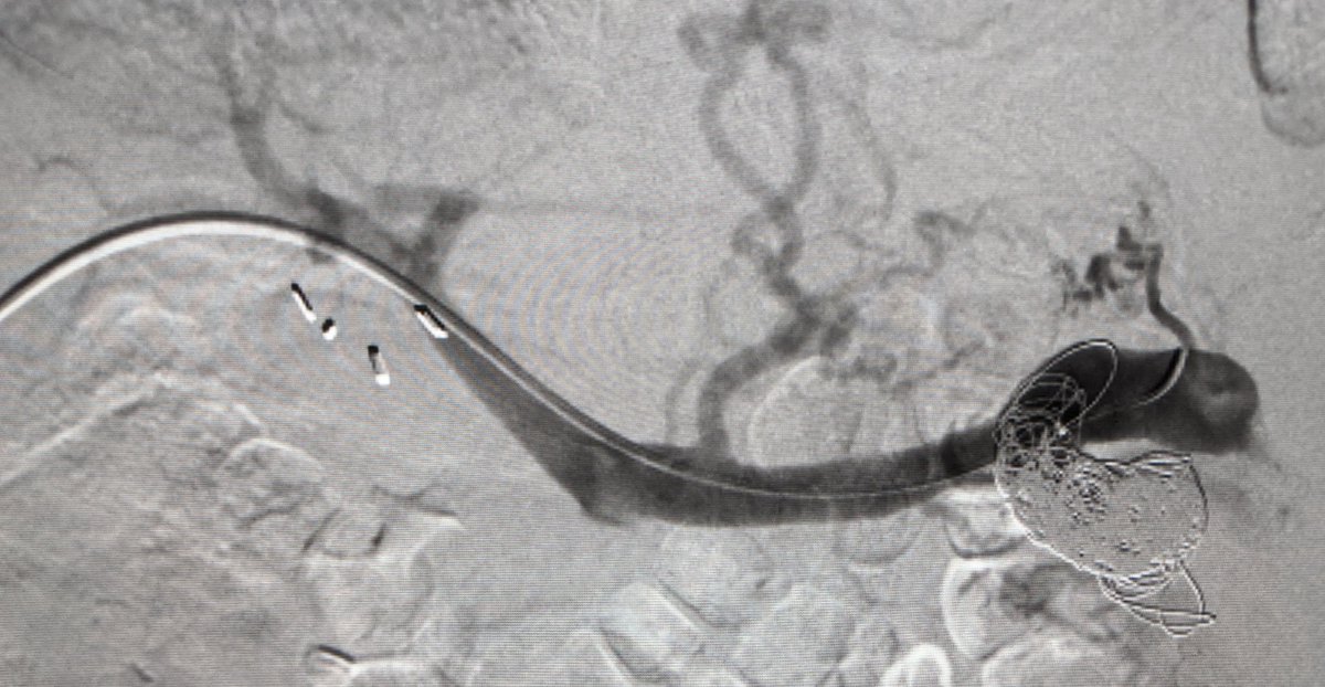 LessneVIR's tweet photo. Beast of a #portosystemic shunt!  T'was a mile wide, I tells you! But, pt w med refractory encephalopathy, so alas, beast needed slaying! Ye ol' pt's mind cleared next day...
@CLTRadiology #IRad 🏴‍☠️ @SIRspecialists @SIR_ECS @SIRRFS
 https://t.co/GUL1hJIH2q https://t.co/aGPasLkStU