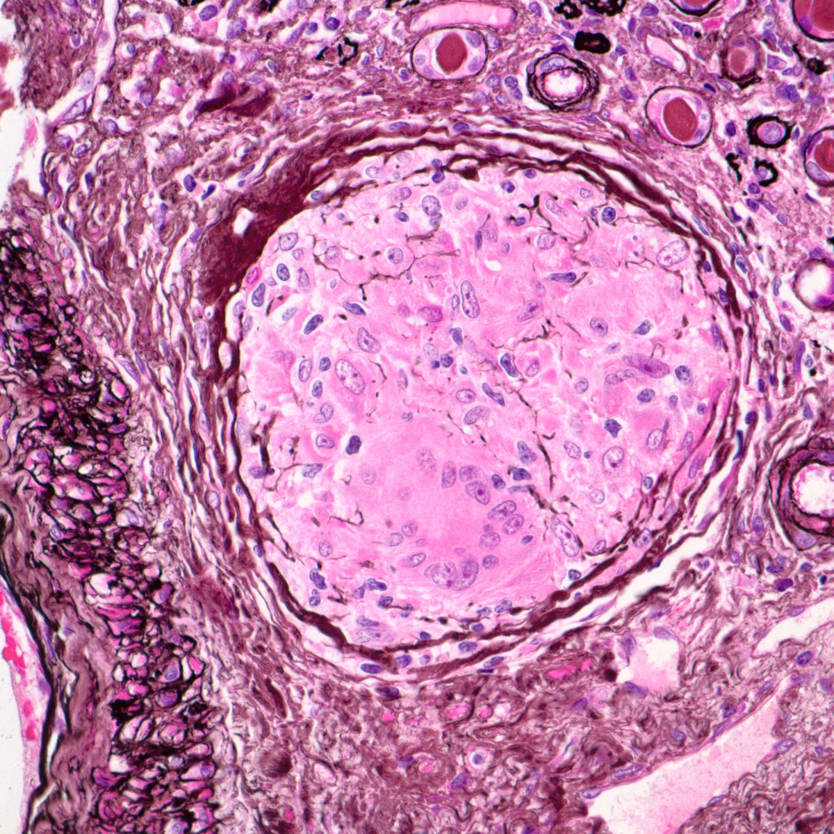 JeanHouMD's tweet photo. Gratuitous granulomas: 41 year old AA F with AKI, hypercalcemia, and lymphadenopathy.  Spectacular granulomatous interstitial nephritis.  Diagnosis anyone? https://t.co/rQZr4ouG7Q