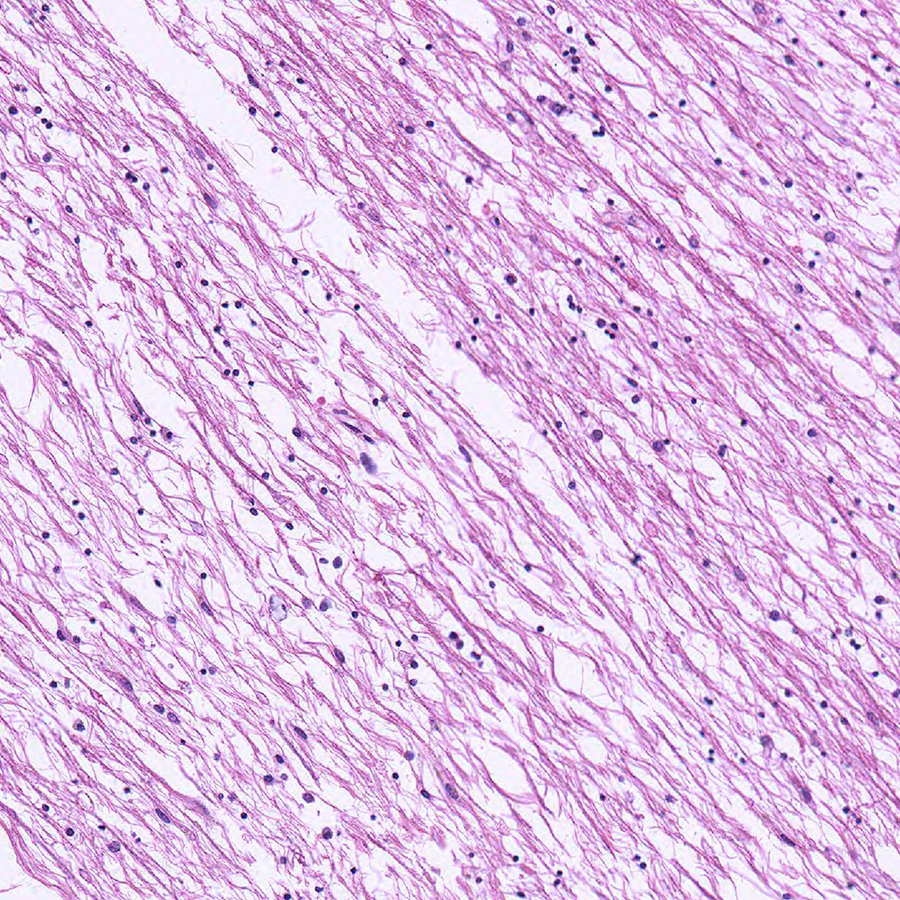 CraigHorbinski's tweet photo. Severe corpus callosum demyelination and atrophy in an #alcoholic. Also known as Marchiafava-Bignami disease. Go easy on the booze. #pathology #pathtwitter #neuropath #alcoholism https://t.co/1y0Cn5Xhlo