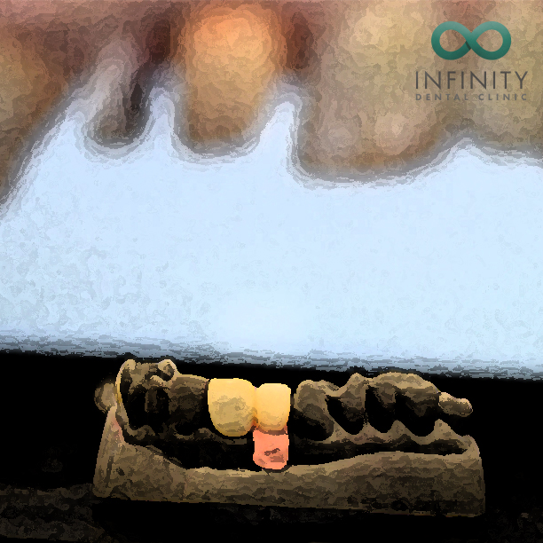 infinity_teeth's tweet image. We're only happy if all of our restorations are a work of art...
ow.ly/md3f50zqXQj
#dentist #smile #art