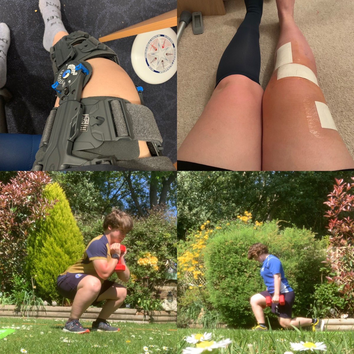 January 25th - fully ruptured ACL
March 4th-ACL reconstruction surgery
April 26th - pain free weighted squats and walking lunges 

It’s slow progress but it’s progress 👌🏼

#acl #surgery #recovery #rehab #slowbutsteady