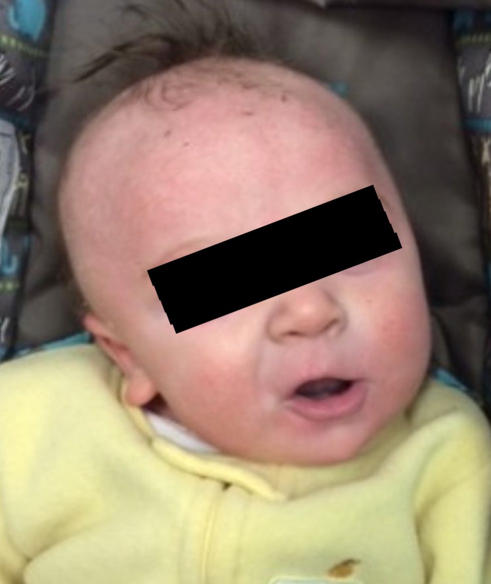 25. Other commonly visible vaccine problems: a droopy mouth & torticollis, when a baby can’t hold their head straight. There are many others I cover in my book, Crooked:Man-made Disease Explained. It’s a fascinating and horrible phenomenon—once you see it, you can’t unsee it.