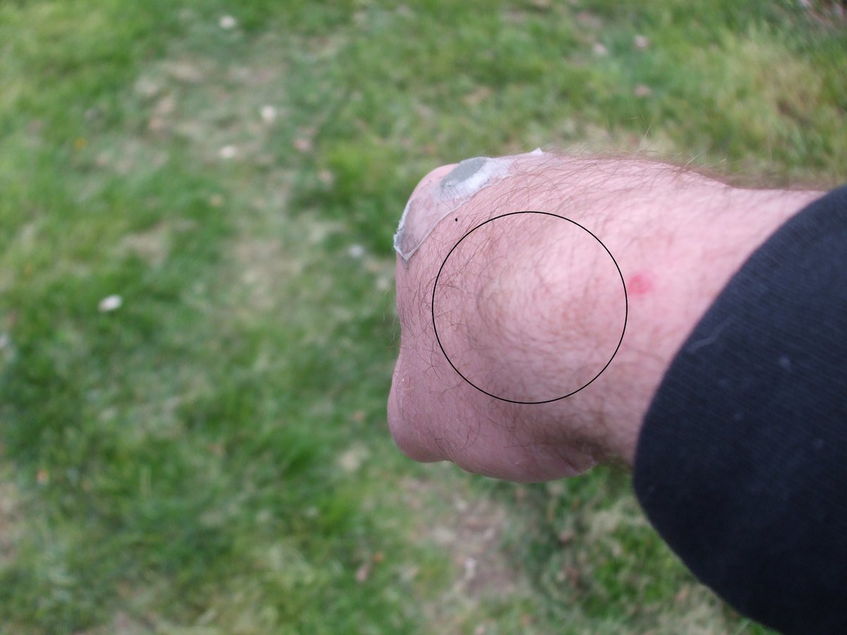 wheeloffreedom1's tweet photo. Just another PAIN ATTACK on my wrist while outside talking to neighbor.. Also, note the magnet on knuckle.. same thing!
THEY can inflame ANY joint within seconds.. Then comes the shocks to CALF, @howiemandel, etc ..
#ChinaWood #SpaceWeapons
@TheJusticeDept @FBI @realDonaldTrump https://t.co/LSoFVuqdxW