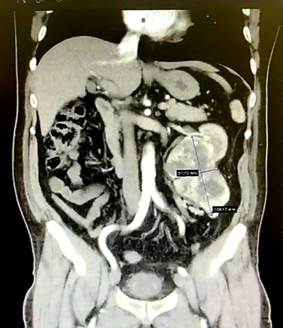 DrRodriguezUro's tweet photo. Semana de tumores renales
Nefrectomia Radical por Tumor Renal T2b

#urology #urologo #monterrey #oncouro #oncology #renaltumor https://t.co/WFMFaq3KDH