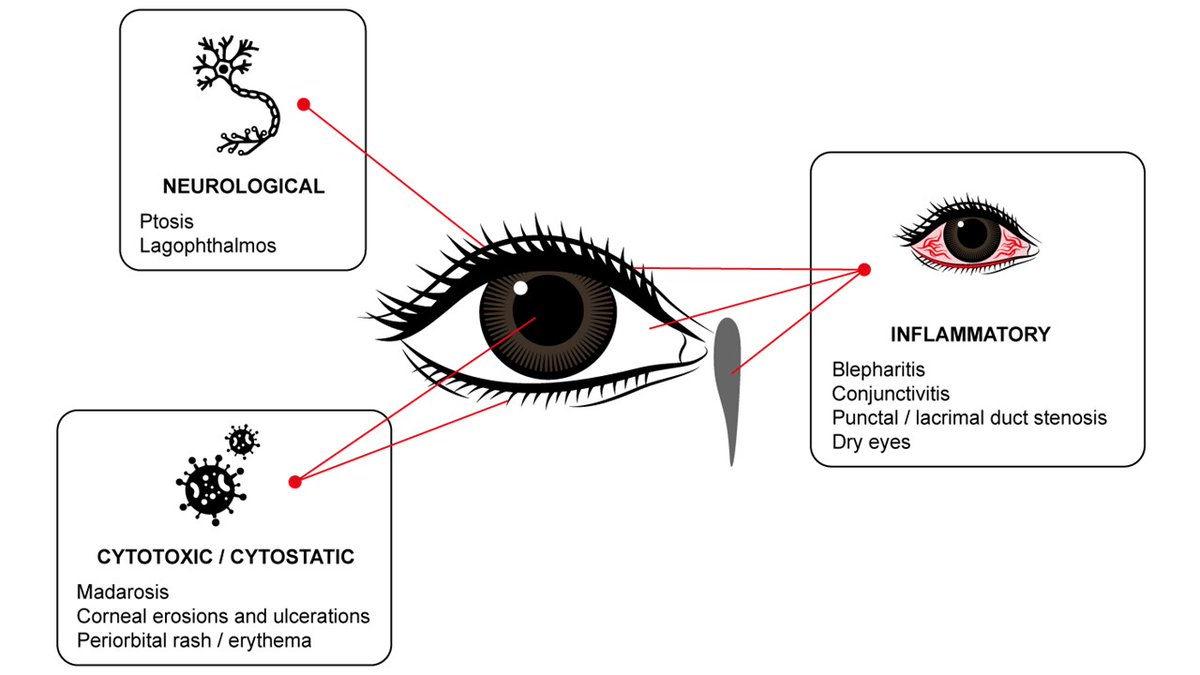 Chemotherapy is widely used in cancer treatment. This collaborative paper between @UNSW and @QUT researchers highlights the impact anticancer drugs can have on the ocular surface #chemotherapy #ocularsurface 
doi.org/10.1016/j.jtos…